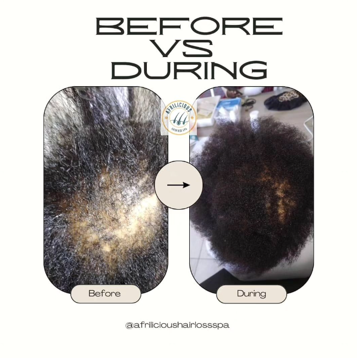 Woman in Windhoek showing hair growth results after 4 months of PRP therapy at Afrilicious