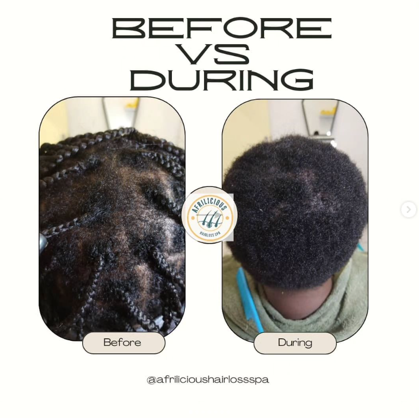 Before and after hair restoration for male client in Swakopmund showing increased density