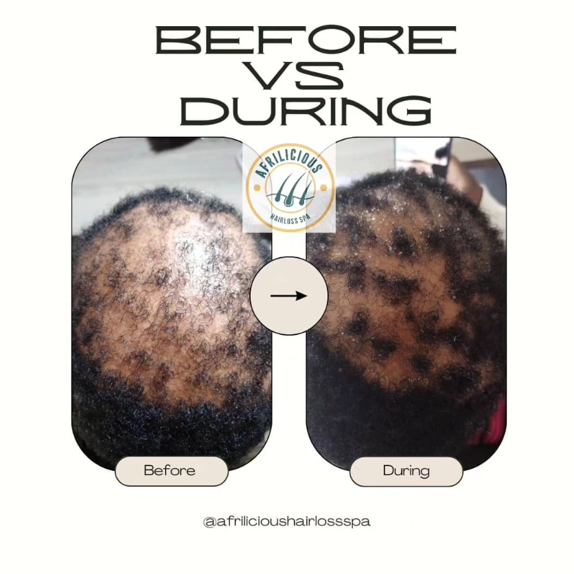 Scalp treatment results showing reduced inflammation and healthier hair growth in Windhoek